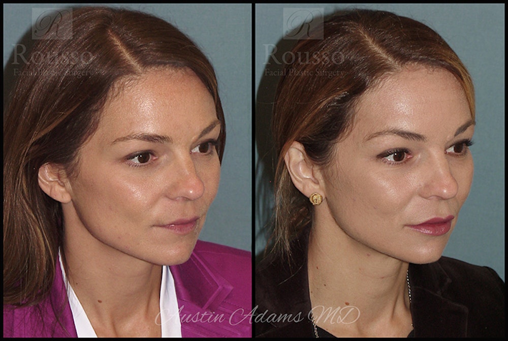 Fillers Gallery Before & After Gallery - Patient 26551171 - Image 3