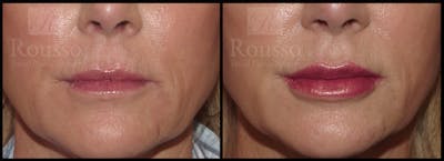 Fillers Before & After Gallery - Patient 26551196 - Image 1