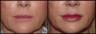 Fillers Gallery Before & After Gallery - Patient 26551196 - Image 1