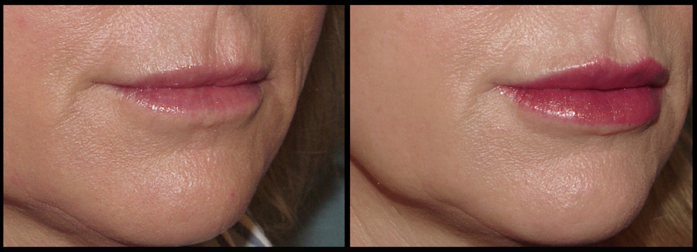 Fillers Before & After Gallery - Patient 26551196 - Image 2