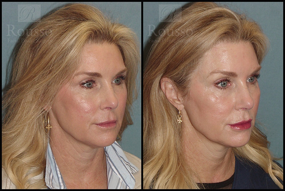 Fillers Gallery Before & After Gallery - Patient 26551196 - Image 3