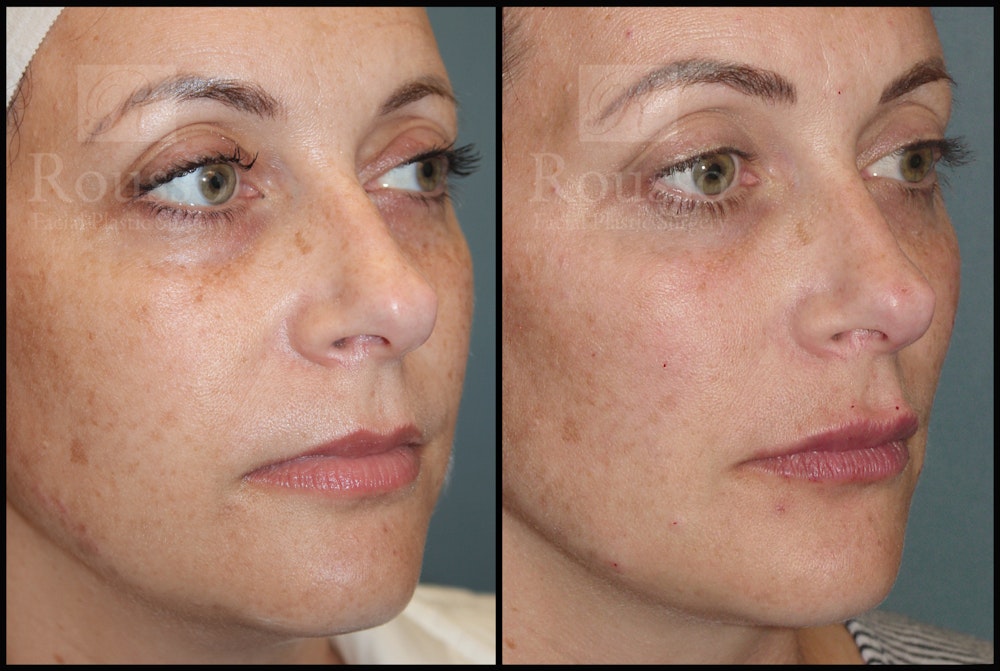 Liquid Facelift Before & After Gallery - Patient 33836196 - Image 1