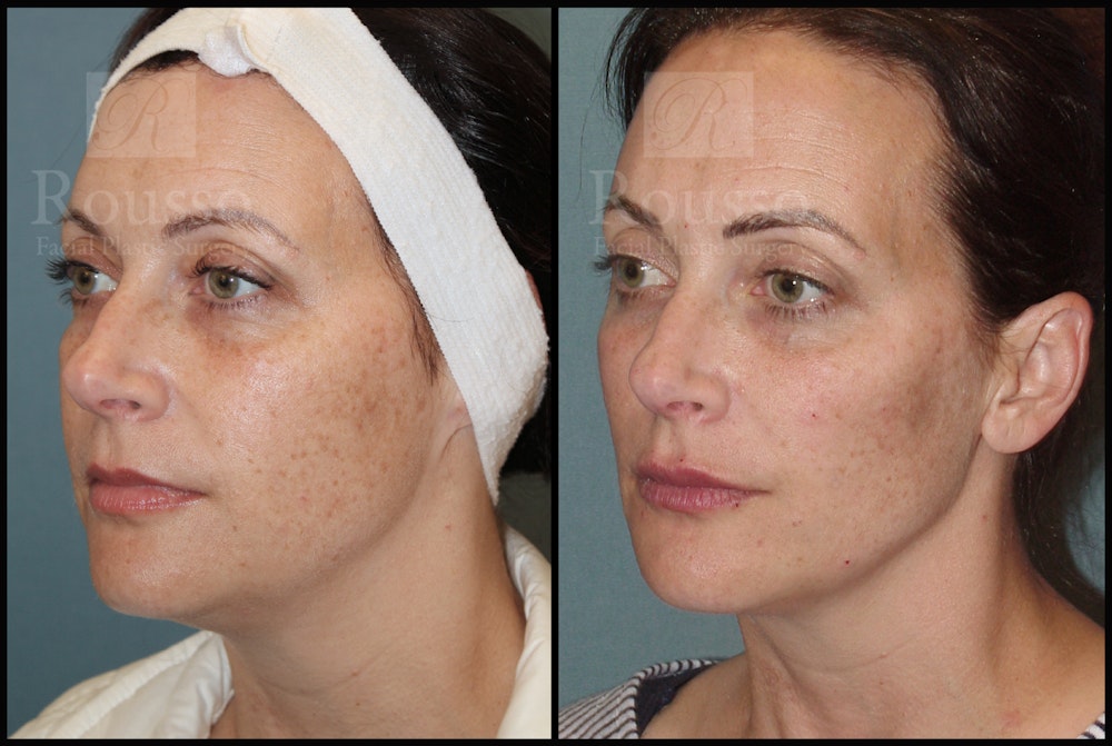 Liquid Facelift Before & After Gallery - Patient 33836196 - Image 2