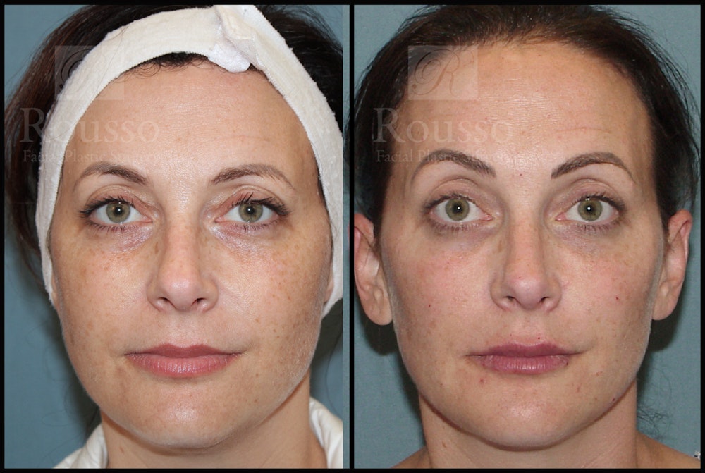 Liquid Facelift Before & After Gallery - Patient 33836196 - Image 3