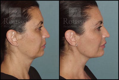 Liquid Facelift Before & After Gallery - Patient 33836203 - Image 1