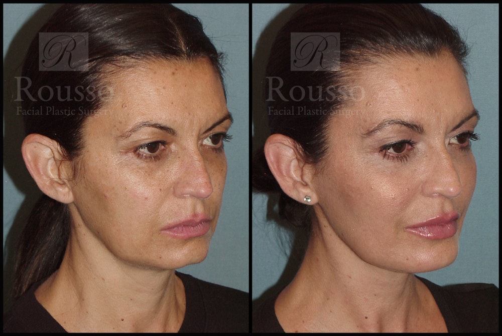 Liquid Facelift Before & After Gallery - Patient 33836203 - Image 2