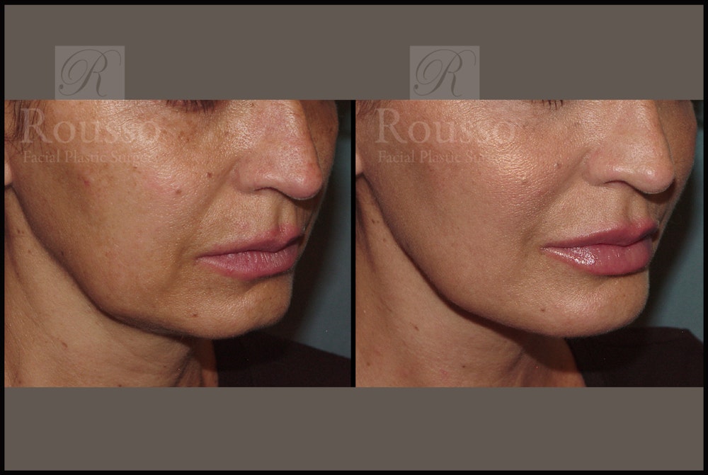 Liquid Facelift Before & After Gallery - Patient 33836203 - Image 3