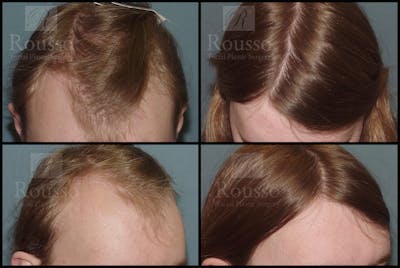 Hair Transplant Before & After Gallery - Patient 37536409 - Image 2