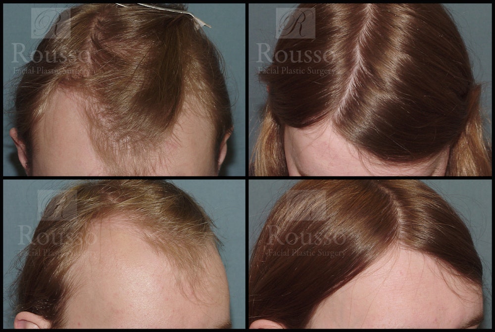 Hair Transplant Gallery - Patient 37536409 - Image 2