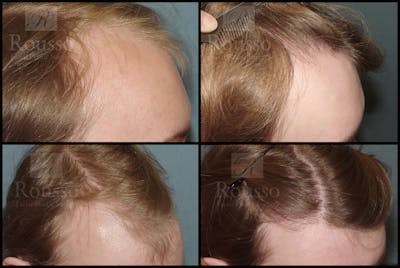 Hair Transplant Before & After Gallery - Patient 37536409 - Image 1