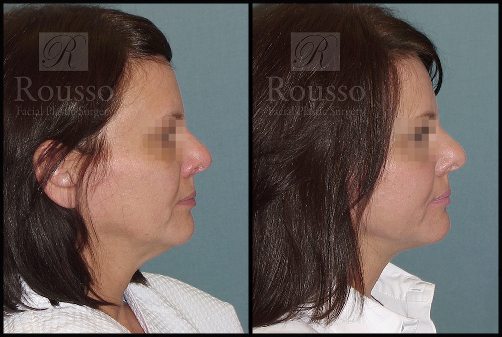 Acculift Before & After Gallery - Patient 44238601 - Image 1