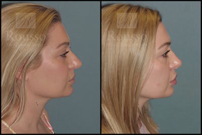 Rhinoplasty Before & After Gallery - Patient 50818352 - Image 1