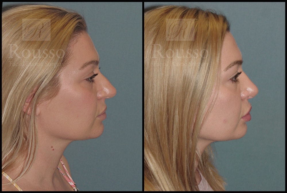 Rhinoplasty Before & After Gallery - Patient 50818352 - Image 1