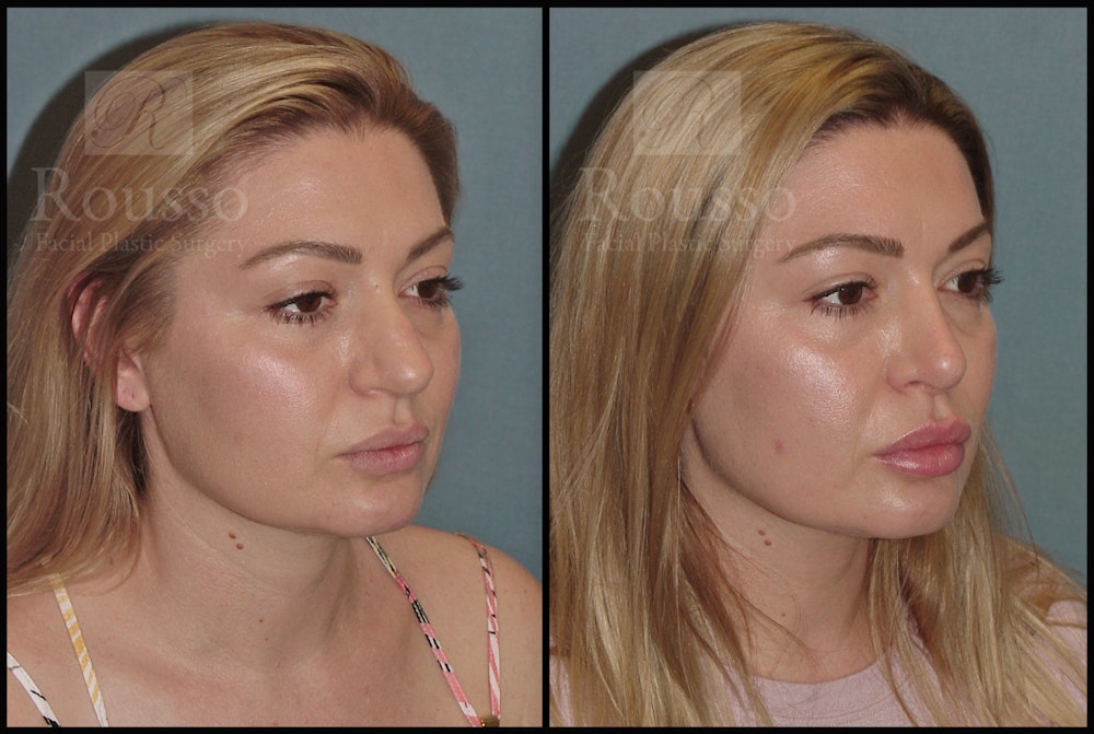 Rhinoplasty <span class=small>By Dr. Daniel Rousso</span> Before & After Gallery - Patient 50818352 - Image 2