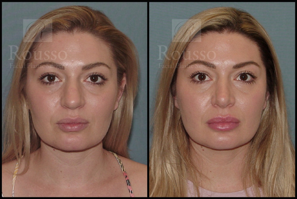 Rhinoplasty Before & After Gallery - Patient 50818352 - Image 3