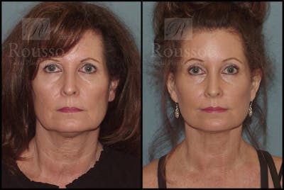 SculptLift™ <span class=small>By Dr. Daniel Rousso</span> Before & After Gallery - Patient 50818365 - Image 1