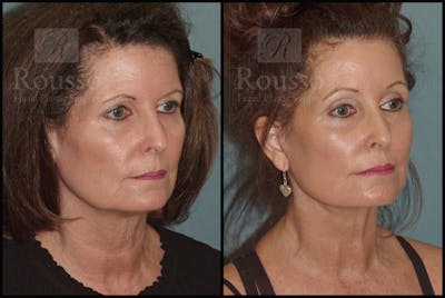 SculptLift™ Before & After Gallery - Patient 50818365 - Image 2