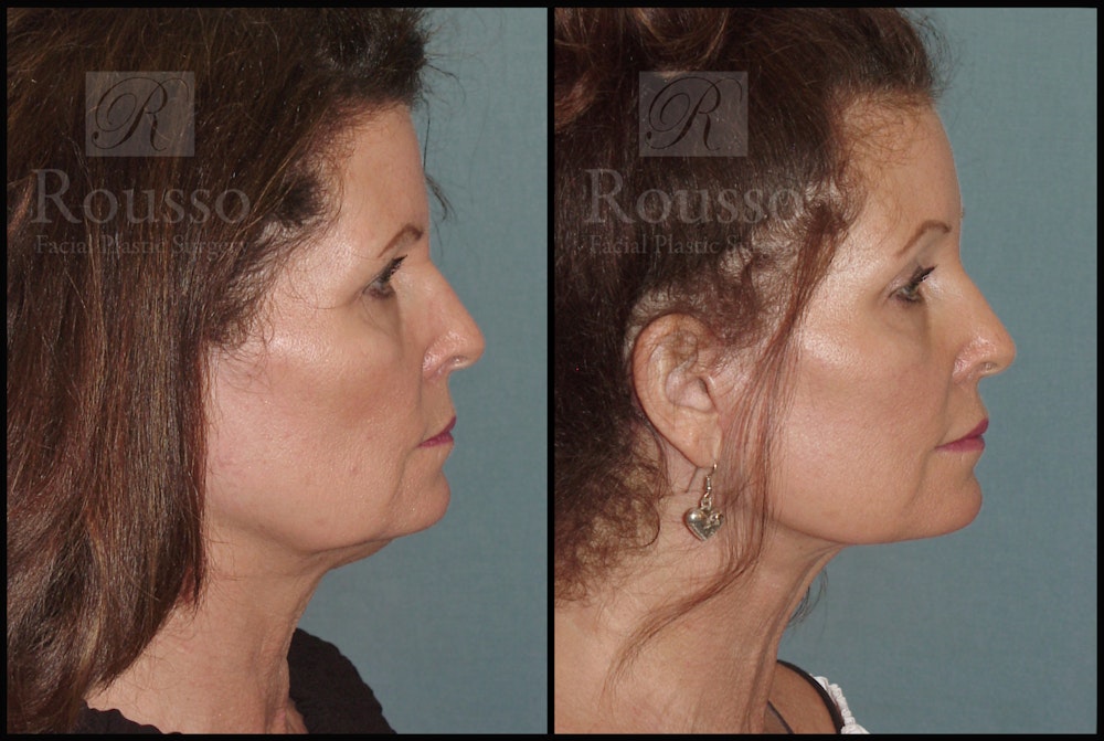 SculptLift™ <span class=small>By Dr. Daniel Rousso</span> Before & After Gallery - Patient 50818365 - Image 3