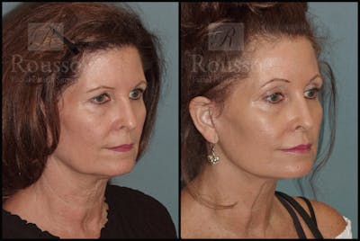 SculptLift™ <span class=small>By Dr. Daniel Rousso</span> Before & After Gallery - Patient 50818365 - Image 4