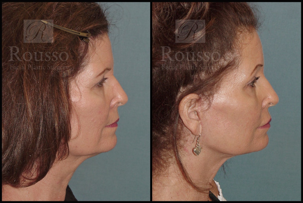 SculptLift™ <span class=small>By Dr. Daniel Rousso</span> Before & After Gallery - Patient 50818365 - Image 5