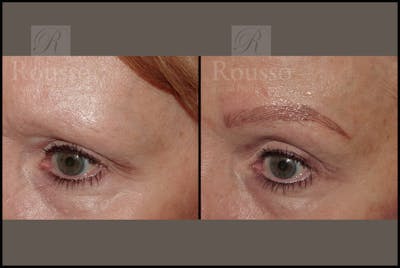 Microblading Before & After Gallery - Patient 50818368 - Image 1