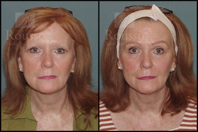 Microblading Before & After Gallery - Patient 50818368 - Image 2