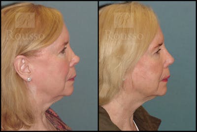 Revision Rhinoplasty Before & After Gallery - Patient 226244 - Image 1