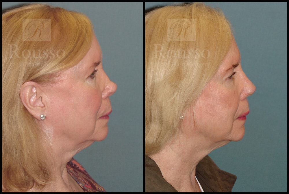 Revision Rhinoplasty <span class=small>By Dr. Daniel Rousso</span> Before & After Gallery - Patient 226244 - Image 1