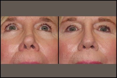 Revision Rhinoplasty <span class=small>By Dr. Daniel Rousso</span> Before & After Gallery - Patient 226244 - Image 2