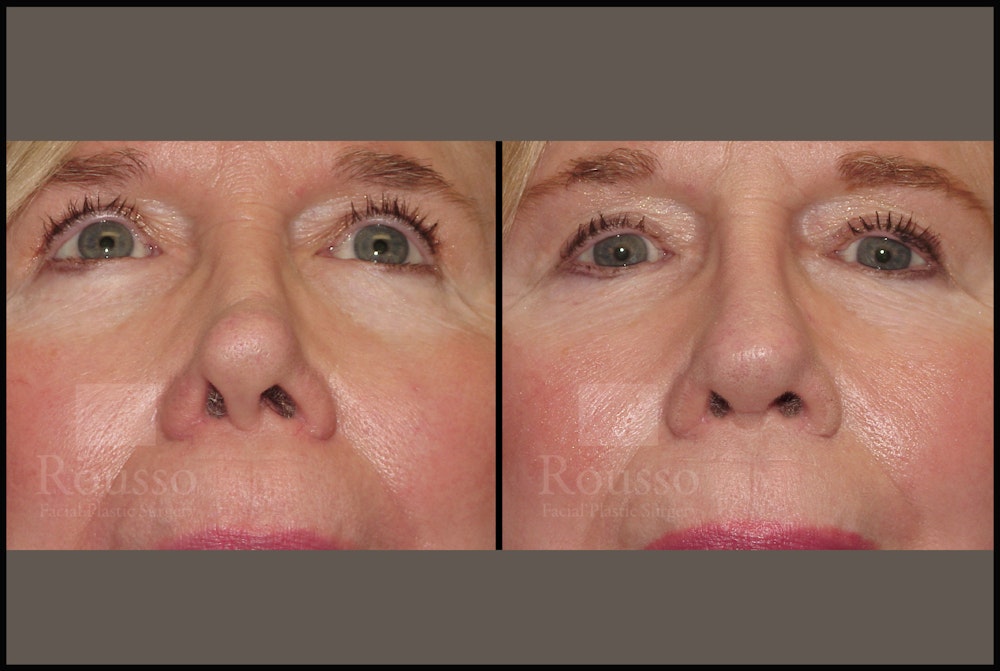 Revision Rhinoplasty Before & After Gallery - Patient 226244 - Image 2