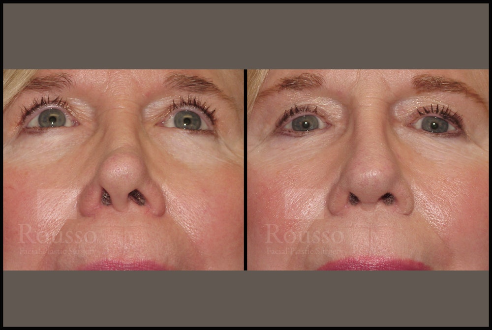 Revision Rhinoplasty <span class=small>By Dr. Daniel Rousso</span> Before & After Gallery - Patient 226244 - Image 2