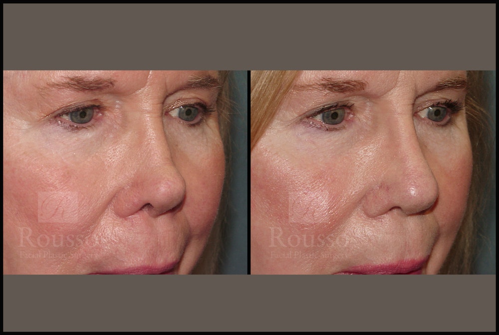 Revision Rhinoplasty <span class=small>By Dr. Daniel Rousso</span> Before & After Gallery - Patient 226244 - Image 3