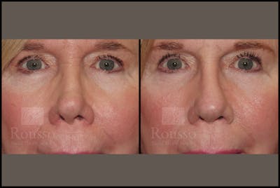 Revision Rhinoplasty Before & After Gallery - Patient 226244 - Image 4
