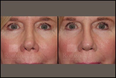 Revision Rhinoplasty <span class=small>By Dr. Daniel Rousso</span> Before & After Gallery - Patient 226244 - Image 4