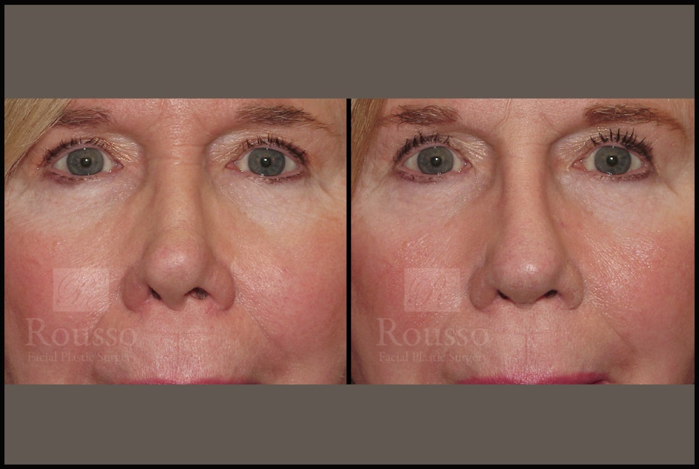 Rhinoplasty Before & After Gallery - Patient 51001384 - Image 4