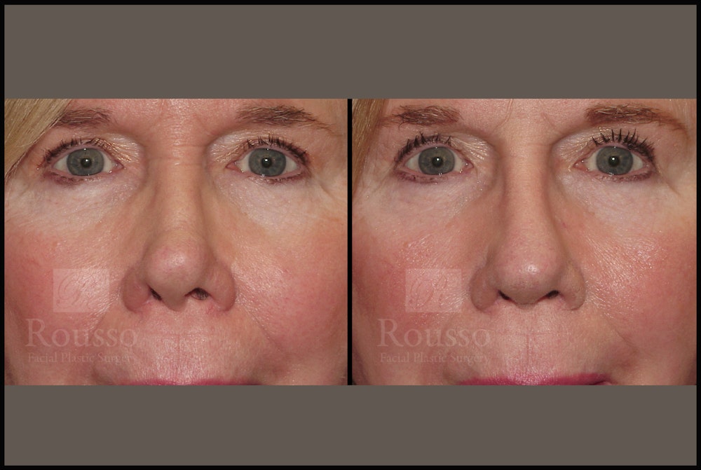 Revision Rhinoplasty <span class=small>By Dr. Daniel Rousso</span> Before & After Gallery - Patient 226244 - Image 4
