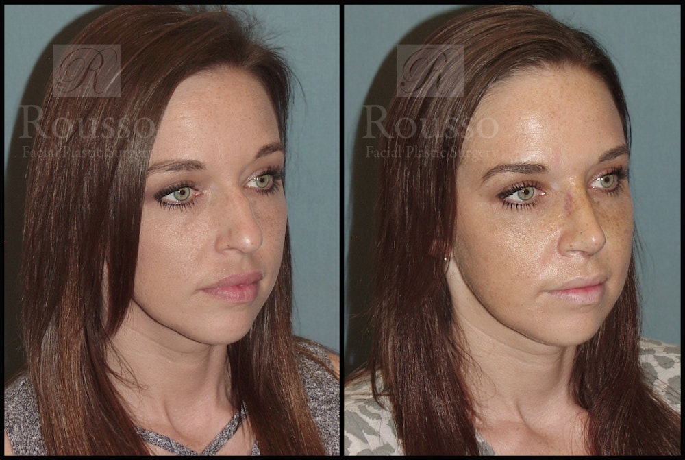 Rhinoplasty Before & After Gallery - Patient 51001402 - Image 1
