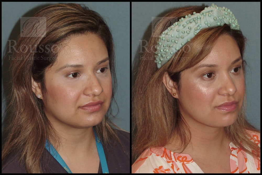 Rhinoplasty Before & After Gallery - Patient 51001403 - Image 1