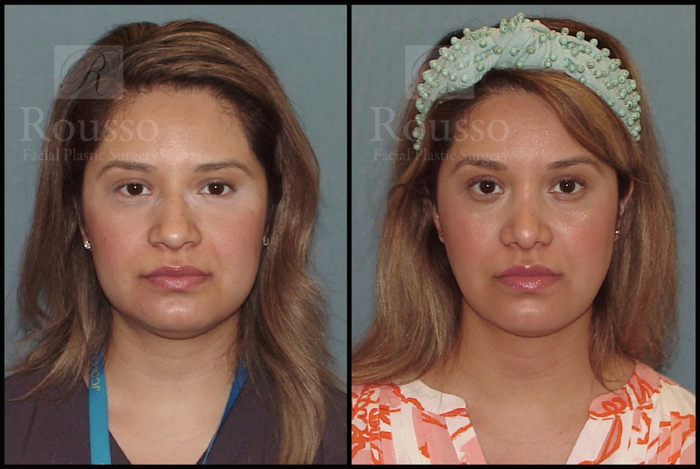 Rhinoplasty Before & After Gallery - Patient 51001403 - Image 2