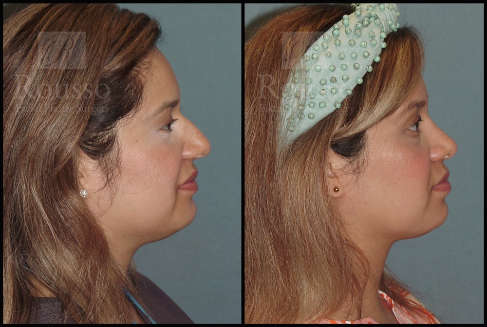 Rhinoplasty Before & After Gallery - Patient 51001403 - Image 3