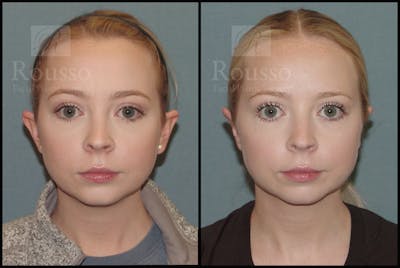 Otoplasty Before & After Gallery - Patient 51001407 - Image 1