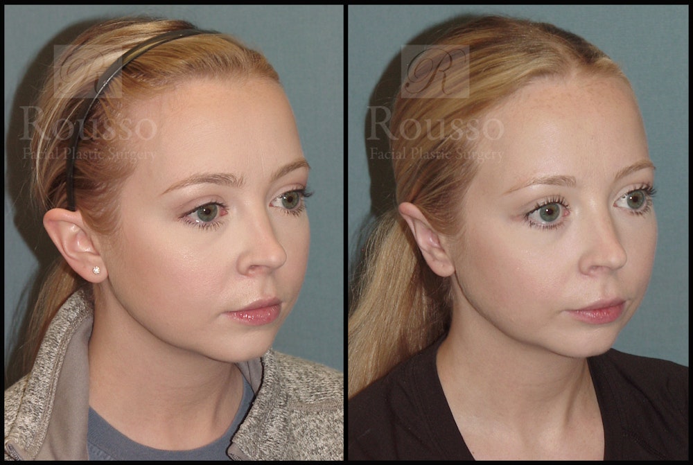 Otoplasty Before & After Gallery - Patient 51001407 - Image 3