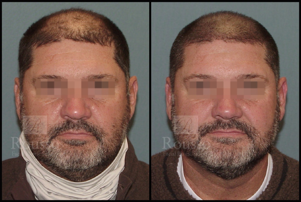 Before & After