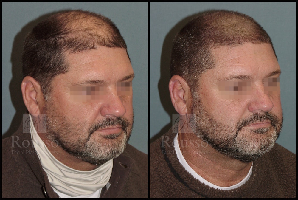 Scalp MicroPigmentation Before & After Gallery - Patient 51667890 - Image 2