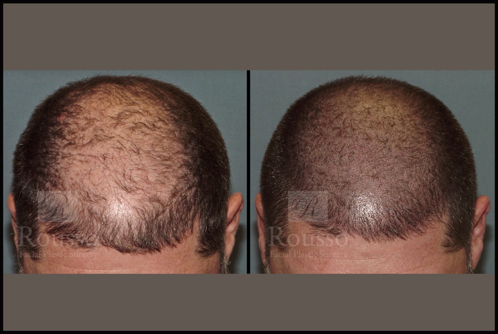 Scalp MicroPigmentation Before & After Gallery - Patient 51667890 - Image 3