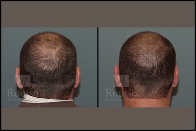 Scalp MicroPigmentation Before & After Gallery - Patient 51667890 - Image 4