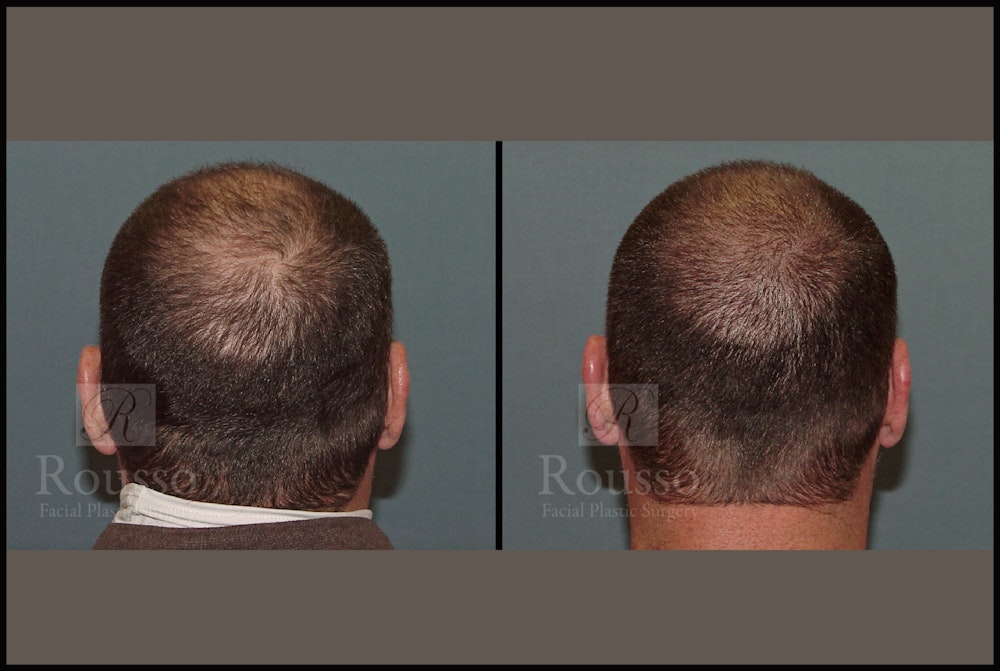 Scalp MicroPigmentation Before & After Gallery - Patient 51667890 - Image 4