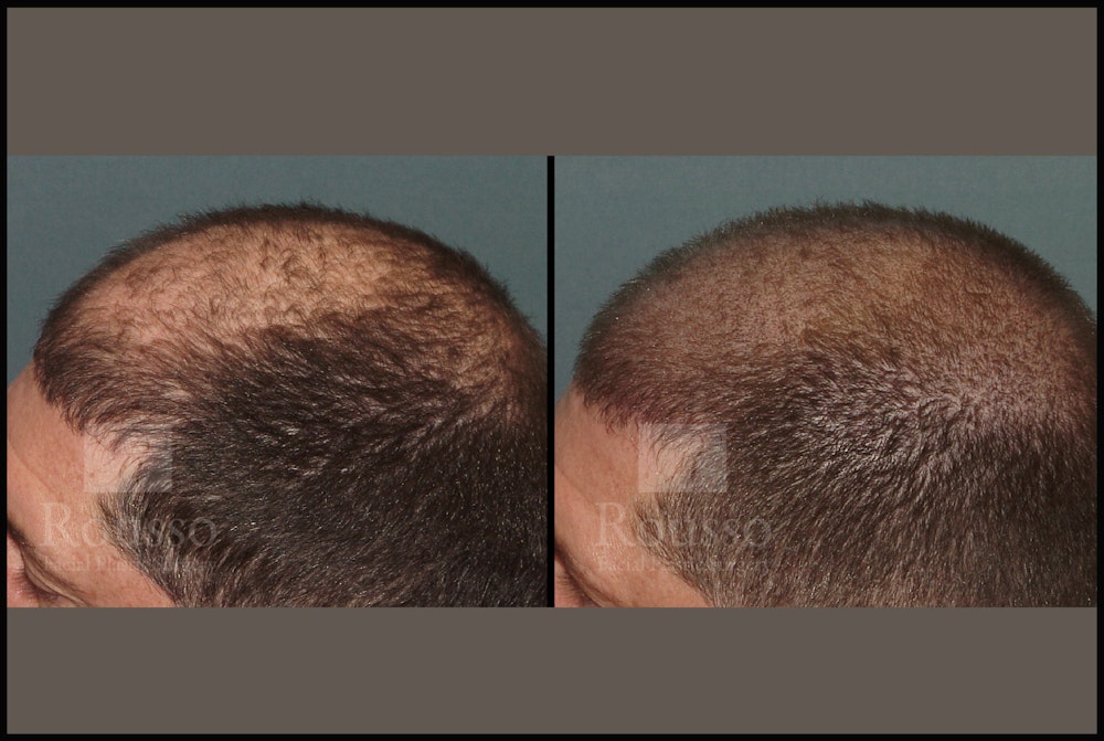 Scalp MicroPigmentation Before & After Gallery - Patient 51667890 - Image 5
