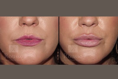 Fillers Before & After Gallery - Patient 52313943 - Image 1