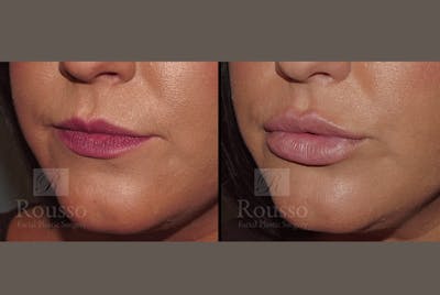 Fillers Before & After Gallery - Patient 52313943 - Image 2